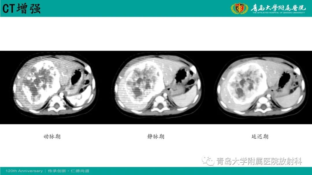 影像PPT - 【病例】婴儿型肝血管内皮细胞瘤2例CT影像-5