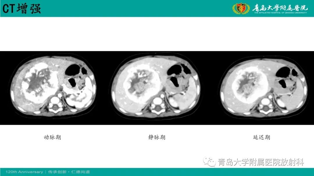影像PPT - 【病例】婴儿型肝血管内皮细胞瘤2例CT影像-7