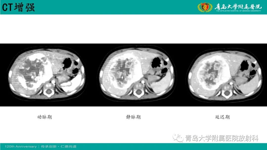 影像PPT - 【病例】婴儿型肝血管内皮细胞瘤2例CT影像-6