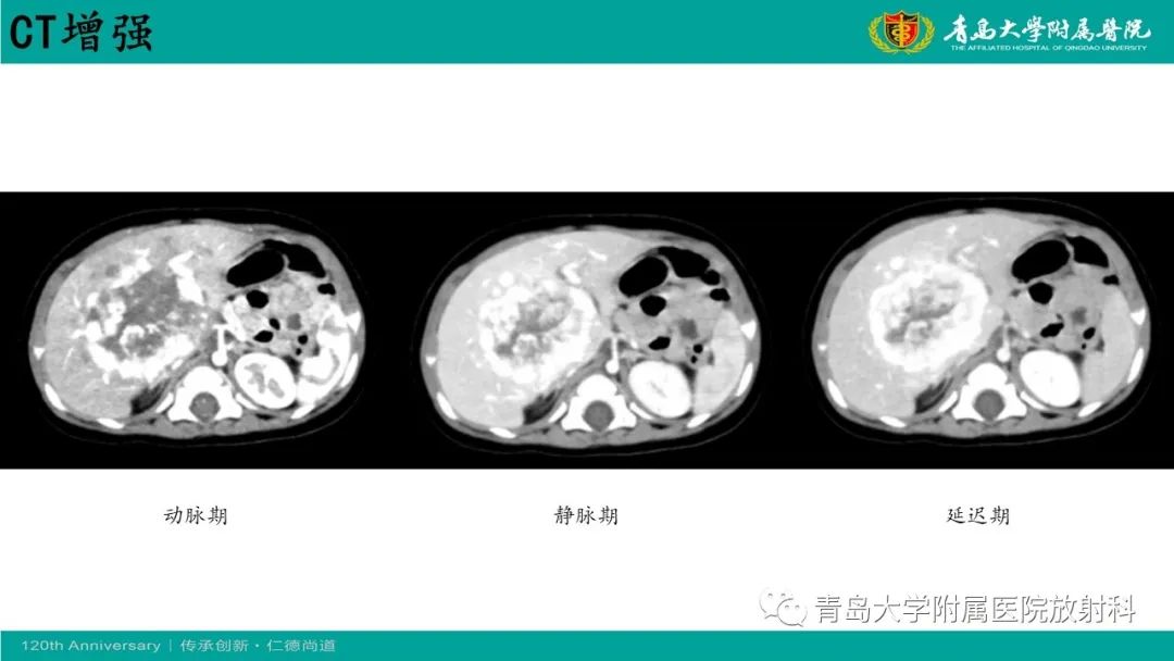 影像PPT - 【病例】婴儿型肝血管内皮细胞瘤2例CT影像-8