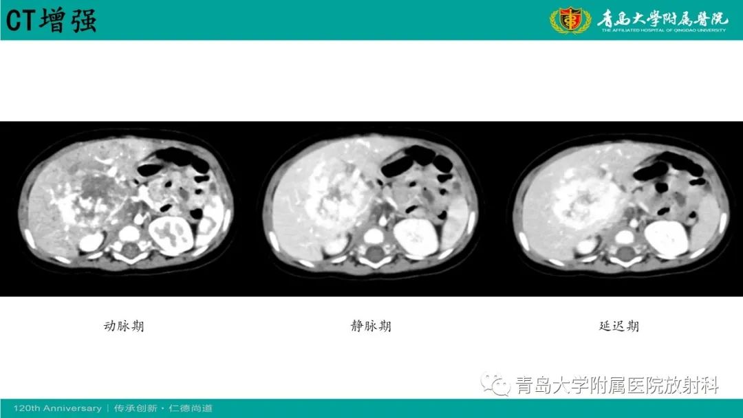 影像PPT - 【病例】婴儿型肝血管内皮细胞瘤2例CT影像-9