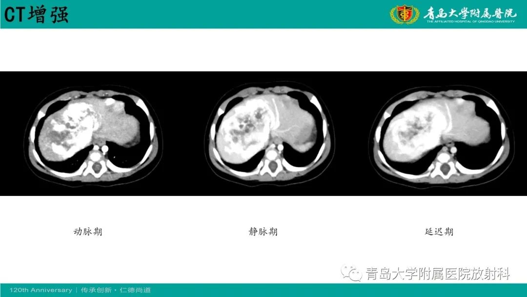 影像PPT - 【病例】婴儿型肝血管内皮细胞瘤2例CT影像-10