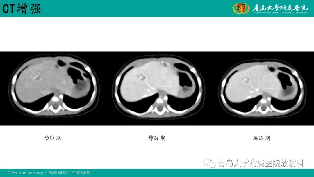 影像PPT - 【病例】婴儿型肝血管内皮细胞瘤2例CT影像-12