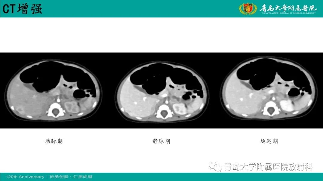 影像PPT - 【病例】婴儿型肝血管内皮细胞瘤2例CT影像-15