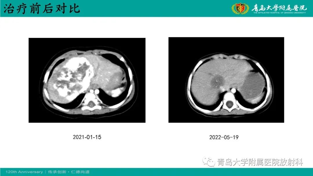 影像PPT - 【病例】婴儿型肝血管内皮细胞瘤2例CT影像-17