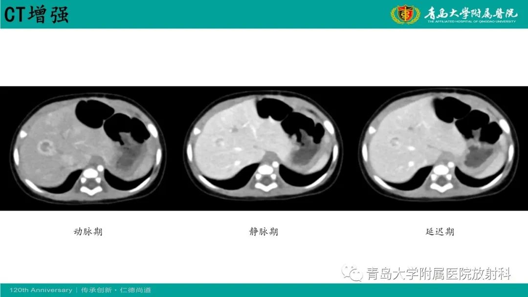 影像PPT - 【病例】婴儿型肝血管内皮细胞瘤2例CT影像-13