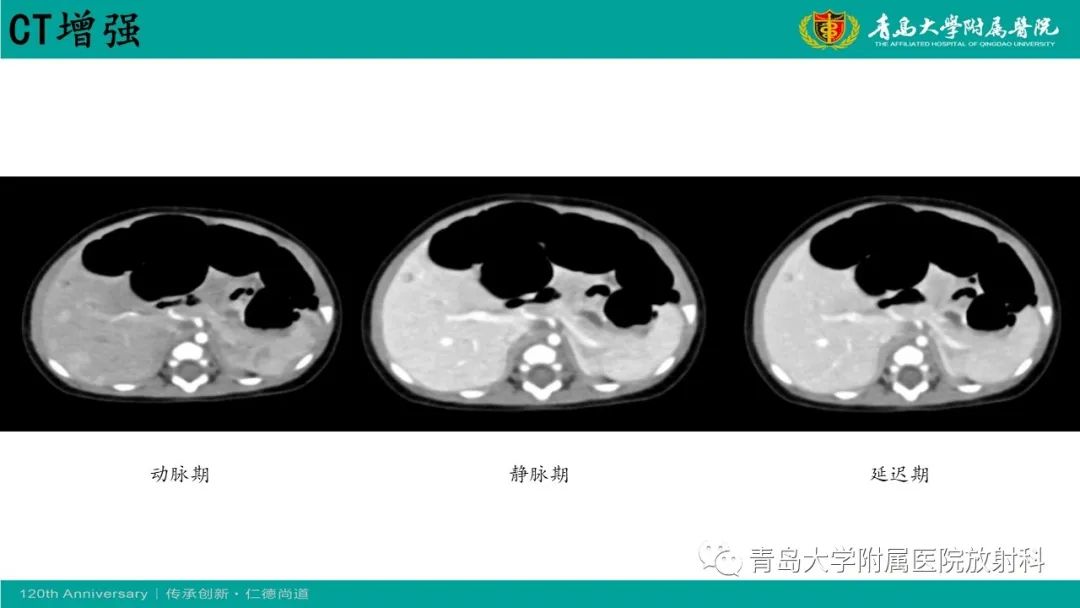 影像PPT - 【病例】婴儿型肝血管内皮细胞瘤2例CT影像-14