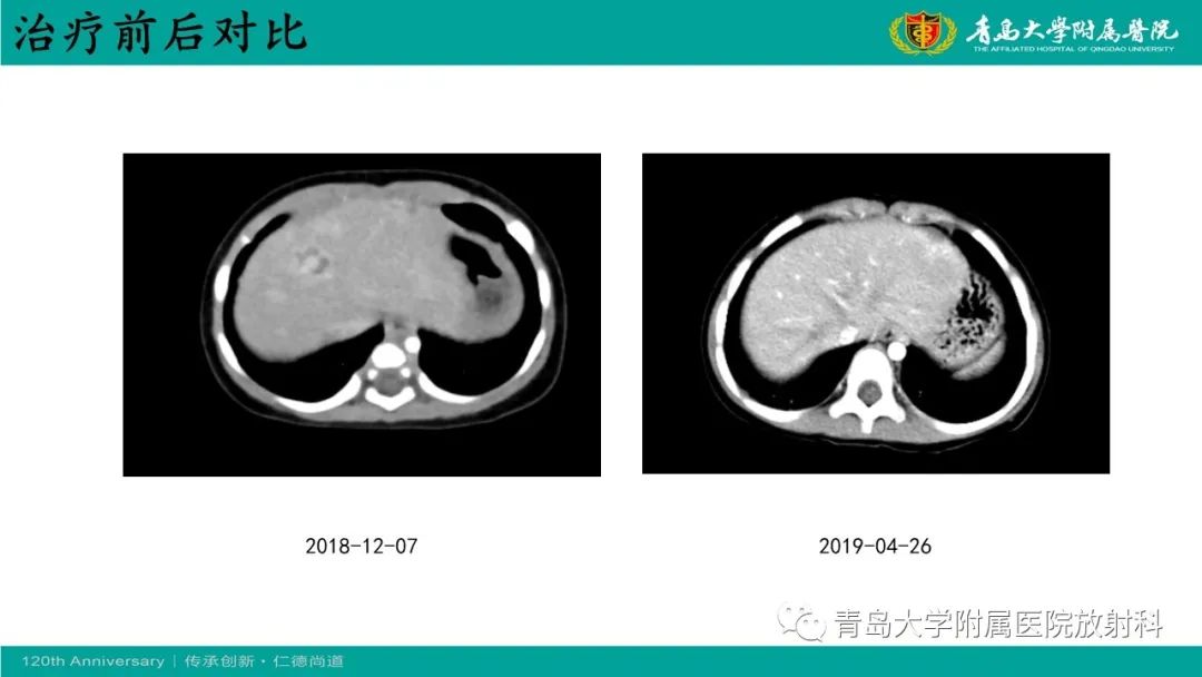 影像PPT - 【病例】婴儿型肝血管内皮细胞瘤2例CT影像-18