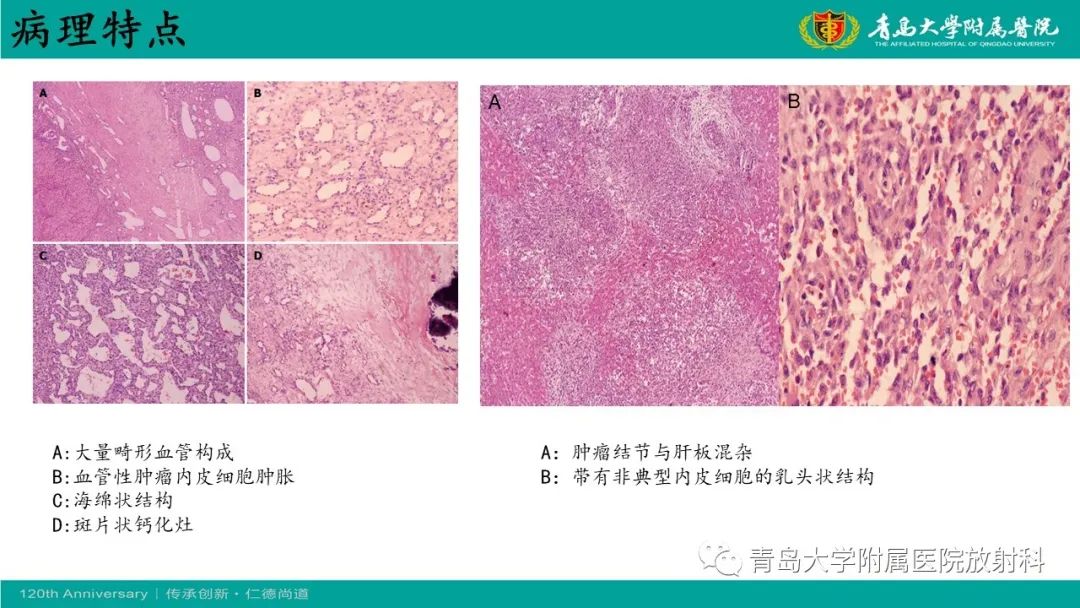 影像PPT - 【病例】婴儿型肝血管内皮细胞瘤2例CT影像-22
