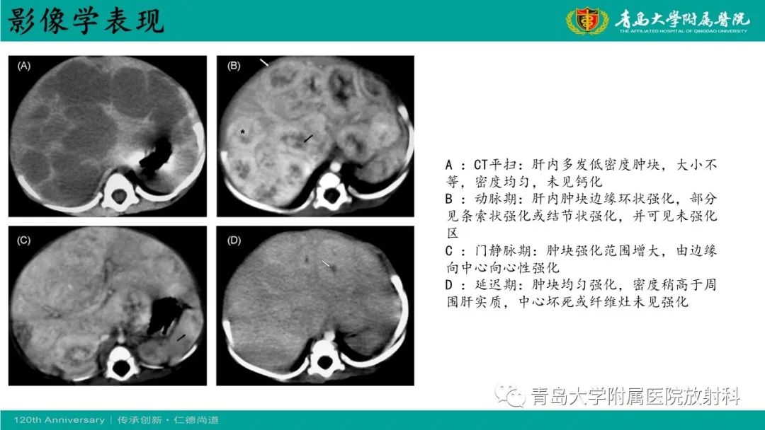 影像PPT - 【病例】婴儿型肝血管内皮细胞瘤2例CT影像-24