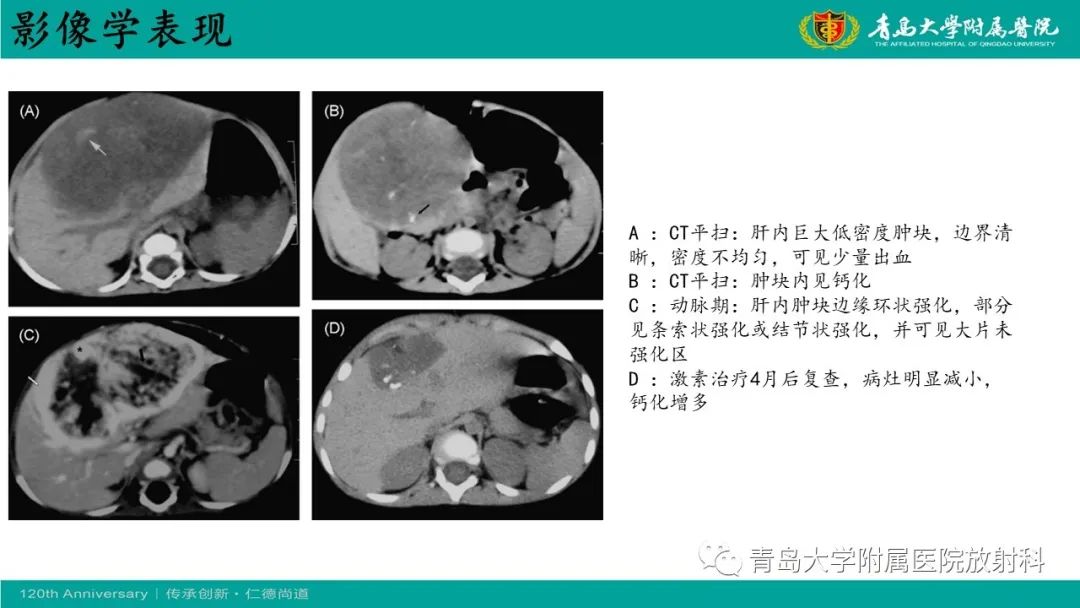 影像PPT - 【病例】婴儿型肝血管内皮细胞瘤2例CT影像-25