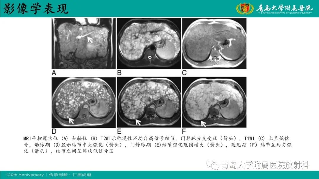 影像PPT - 【病例】婴儿型肝血管内皮细胞瘤2例CT影像-28