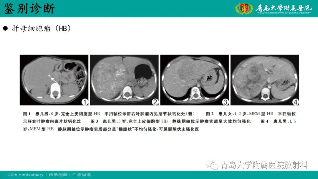 影像PPT - 【病例】婴儿型肝血管内皮细胞瘤2例CT影像-31