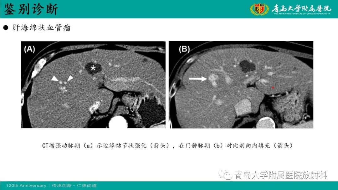 影像PPT - 【病例】婴儿型肝血管内皮细胞瘤2例CT影像-33