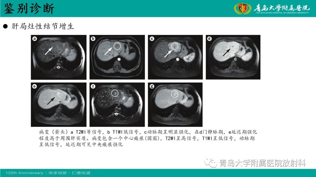 影像PPT - 【病例】婴儿型肝血管内皮细胞瘤2例CT影像-35