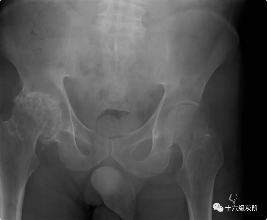 影像PPT - 髋关节骨关节炎分级-2