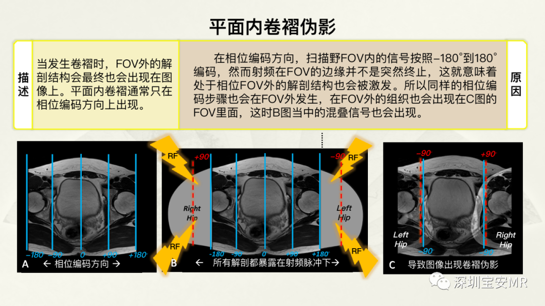 影像PPT - 【PPT】常见的MRI伪影和应对策略-4