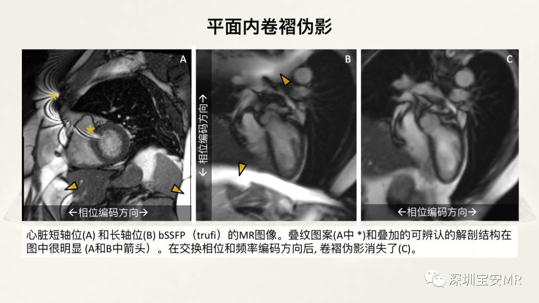 影像PPT - 【PPT】常见的MRI伪影和应对策略-6