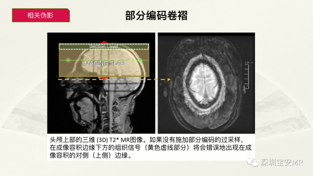 影像PPT - 【PPT】常见的MRI伪影和应对策略-7