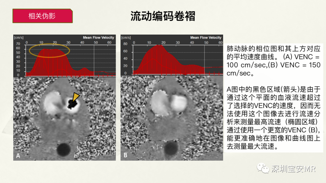 影像PPT - 【PPT】常见的MRI伪影和应对策略-8