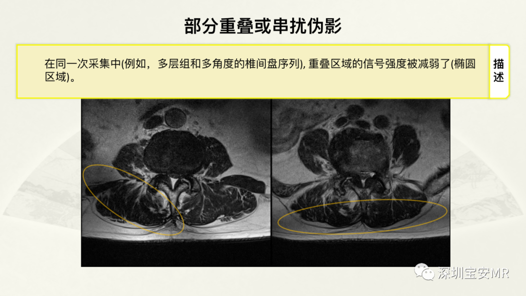 影像PPT - 【PPT】常见的MRI伪影和应对策略-11