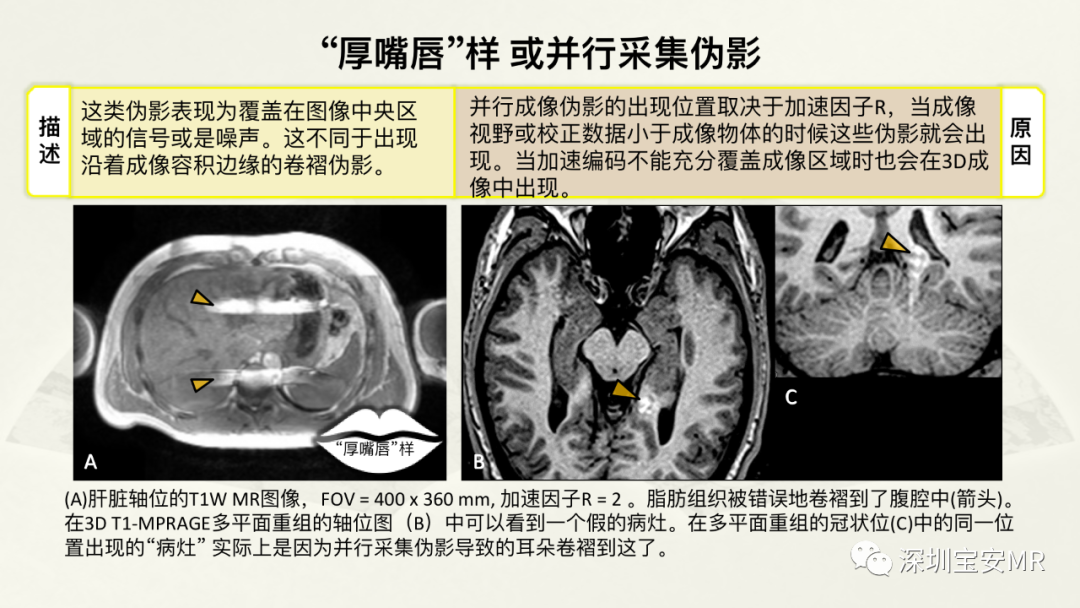 影像PPT - 【PPT】常见的MRI伪影和应对策略-13
