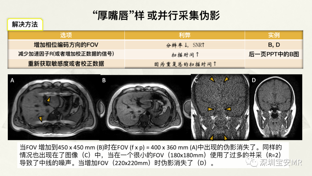 影像PPT - 【PPT】常见的MRI伪影和应对策略-14