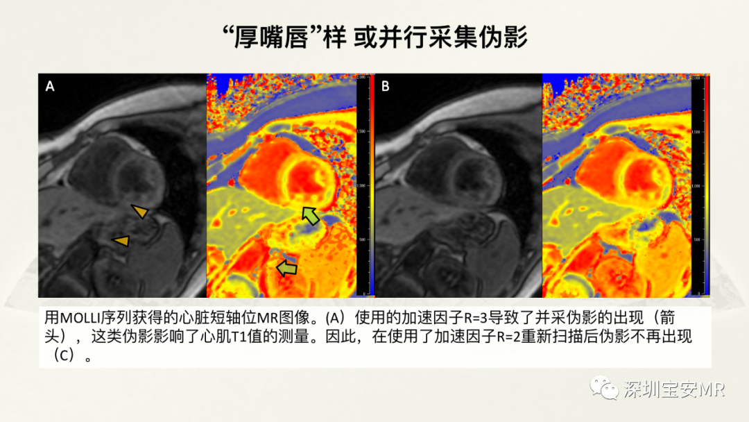 影像PPT - 【PPT】常见的MRI伪影和应对策略-15