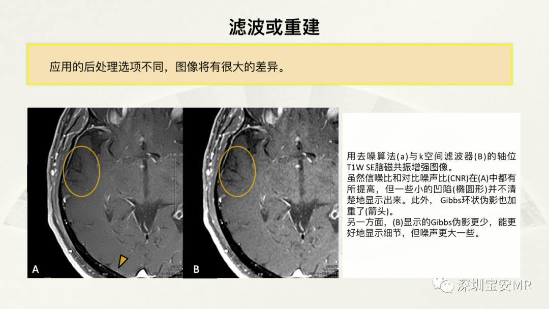 影像PPT - 【PPT】常见的MRI伪影和应对策略-21