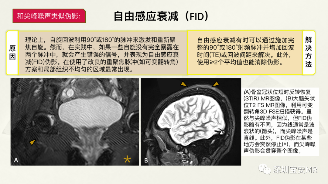 影像PPT - 【PPT】常见的MRI伪影和应对策略-28