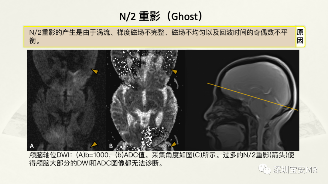 影像PPT - 【PPT】常见的MRI伪影和应对策略-29