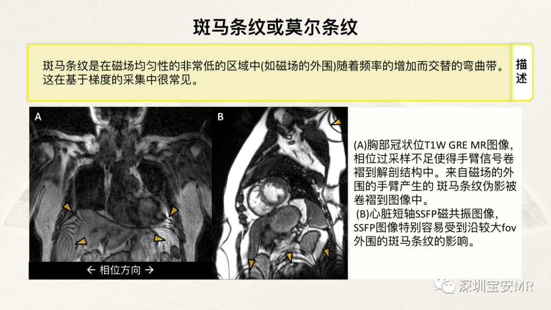 影像PPT - 【PPT】常见的MRI伪影和应对策略-31