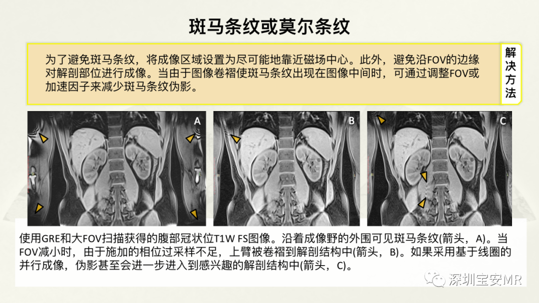 影像PPT - 【PPT】常见的MRI伪影和应对策略-32