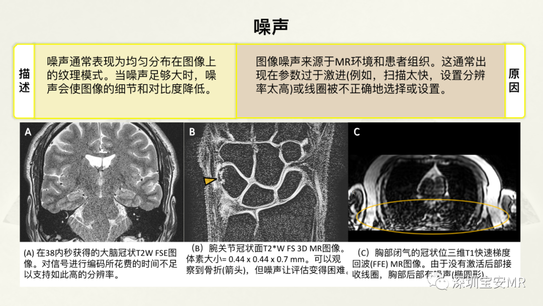 影像PPT - 【PPT】常见的MRI伪影和应对策略-33