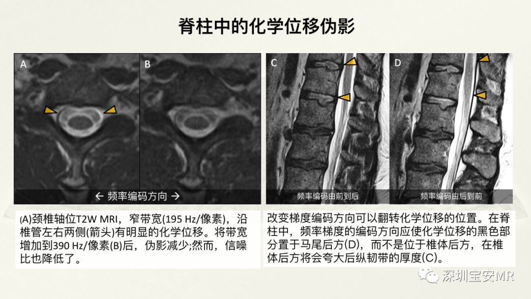 影像PPT - 【PPT】常见的MRI伪影和应对策略-39