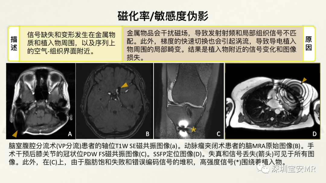 影像PPT - 【PPT】常见的MRI伪影和应对策略-44