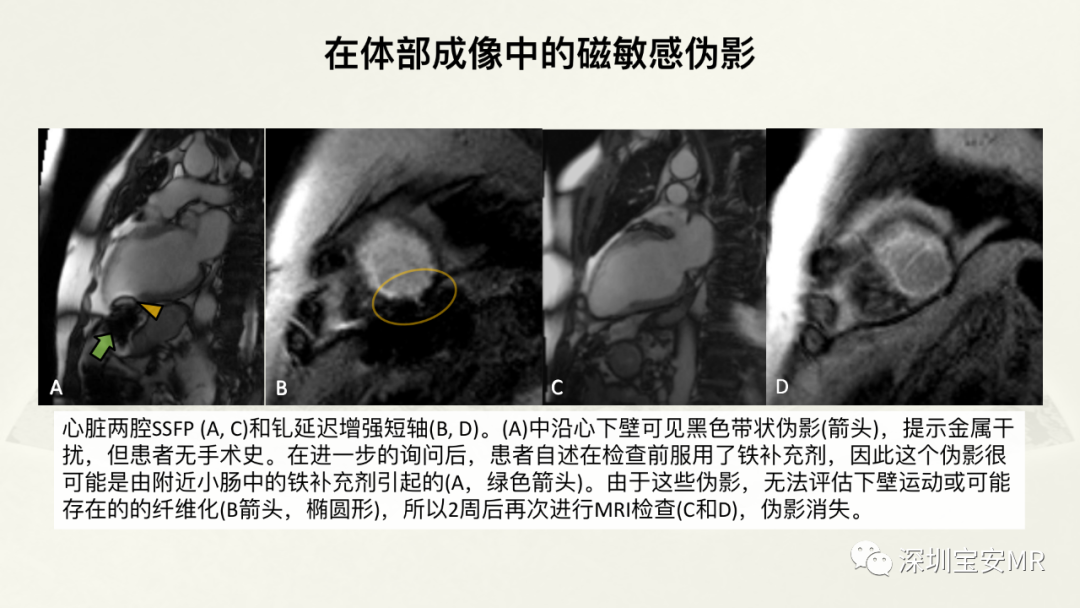 影像PPT - 【PPT】常见的MRI伪影和应对策略-47