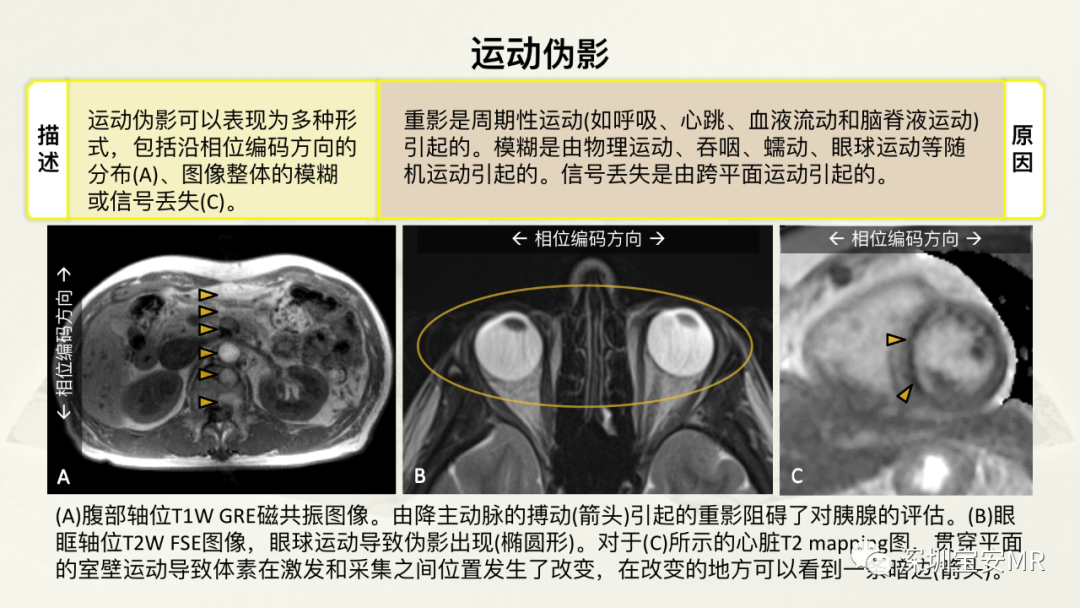 影像PPT - 【PPT】常见的MRI伪影和应对策略-49