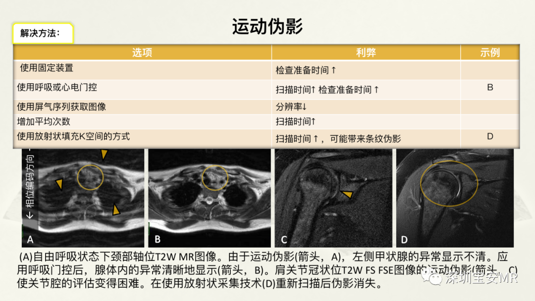 影像PPT - 【PPT】常见的MRI伪影和应对策略-50