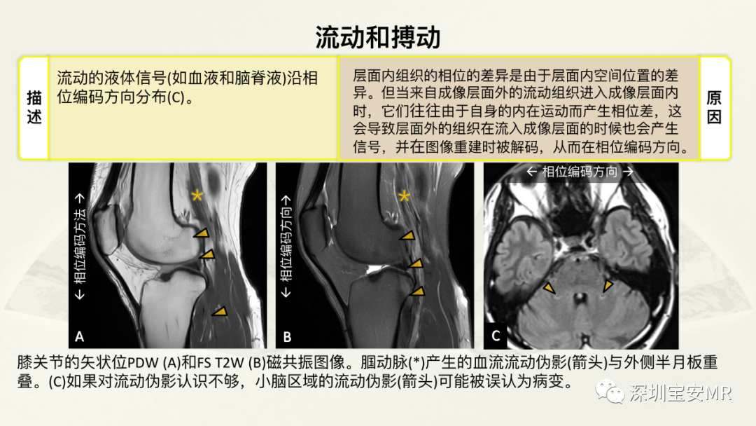 影像PPT - 【PPT】常见的MRI伪影和应对策略-51