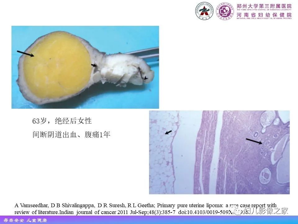 影像PPT - 【PPT】 子宫脂肪瘤-5