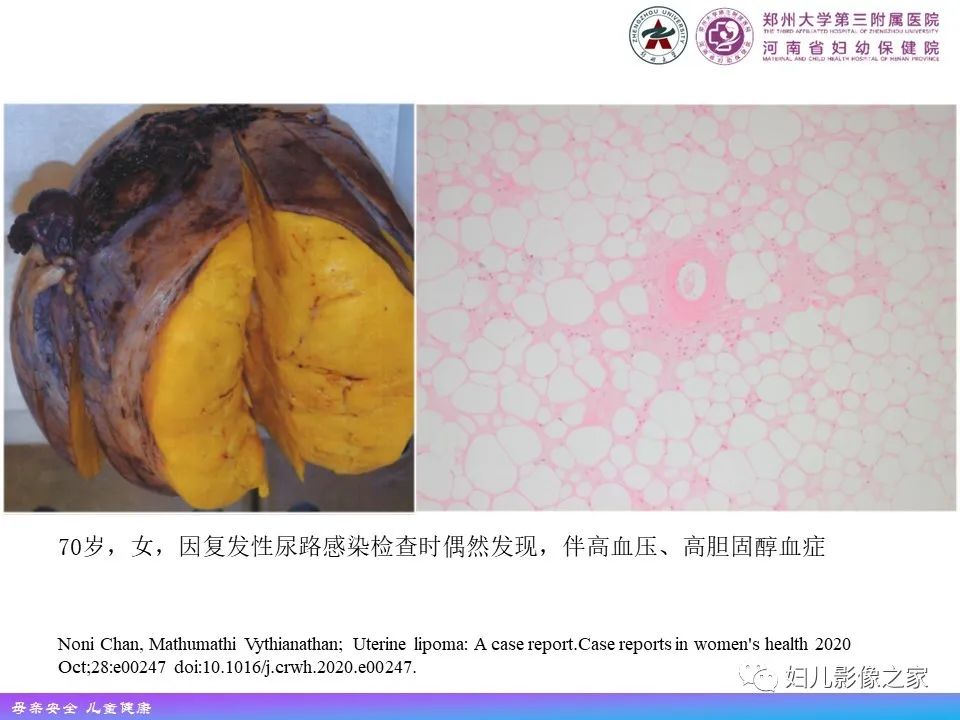 影像PPT - 【PPT】 子宫脂肪瘤-6