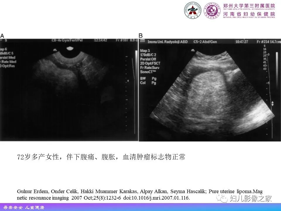 影像PPT - 【PPT】 子宫脂肪瘤-10