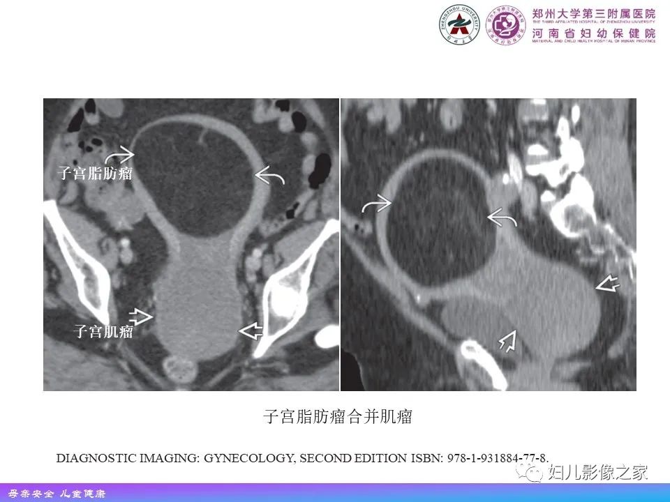 影像PPT - 【PPT】 子宫脂肪瘤-12