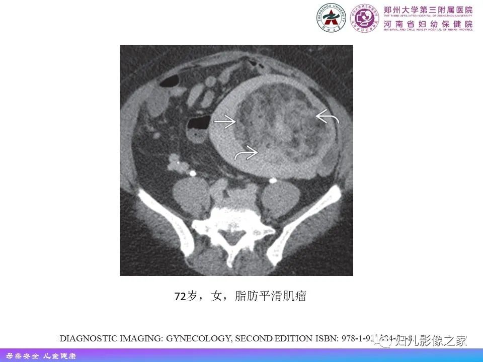 影像PPT - 【PPT】 子宫脂肪瘤-13