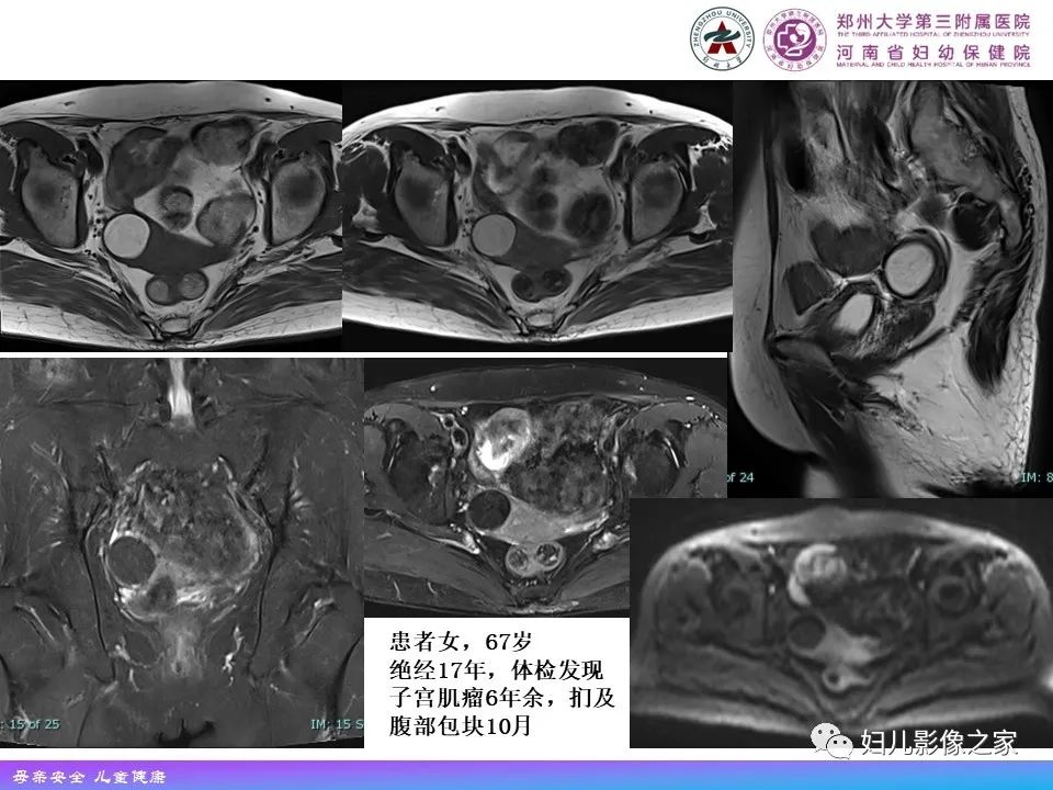 影像PPT - 【PPT】 子宫脂肪瘤-15