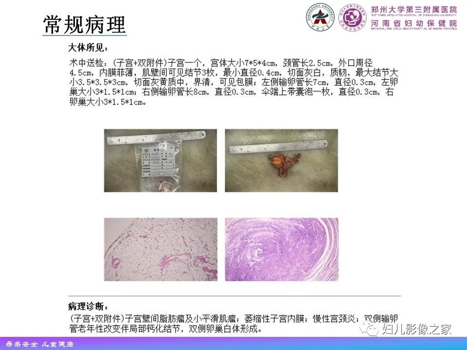 影像PPT - 【PPT】 子宫脂肪瘤-16