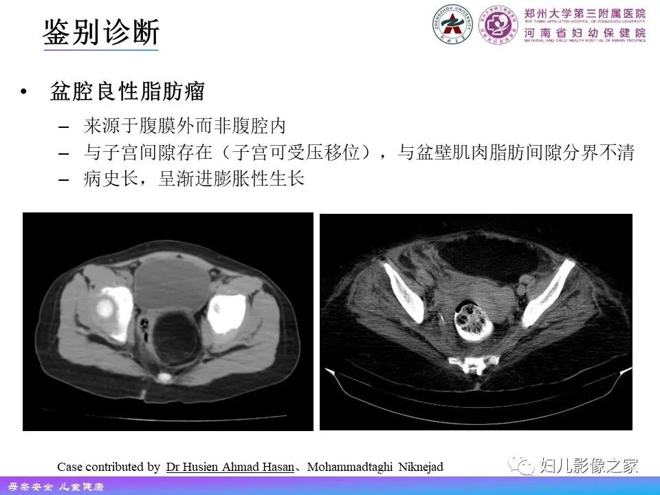 影像PPT - 【PPT】 子宫脂肪瘤-19