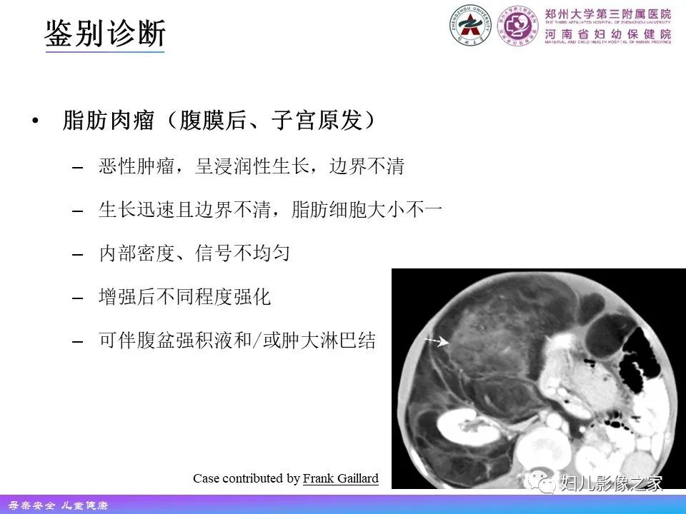 影像PPT - 【PPT】 子宫脂肪瘤-21