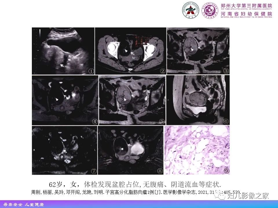 影像PPT - 【PPT】 子宫脂肪瘤-22